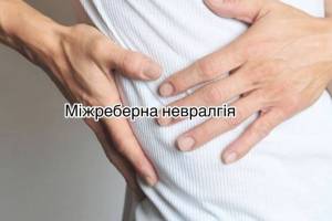 Міжреберна невралгія