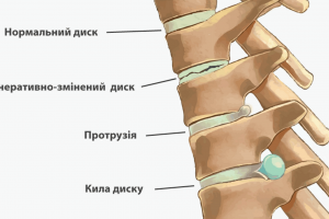 Протрузія - це своєрідний «дзвіночок перед пожаром»